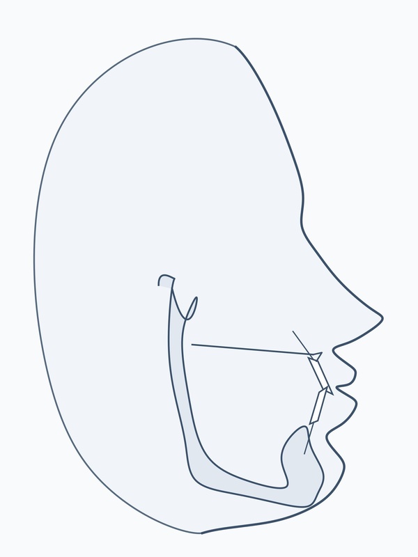 18. Cephalo